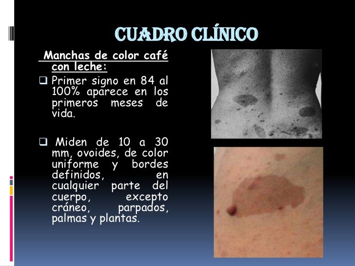 facomatosis oftalmologia